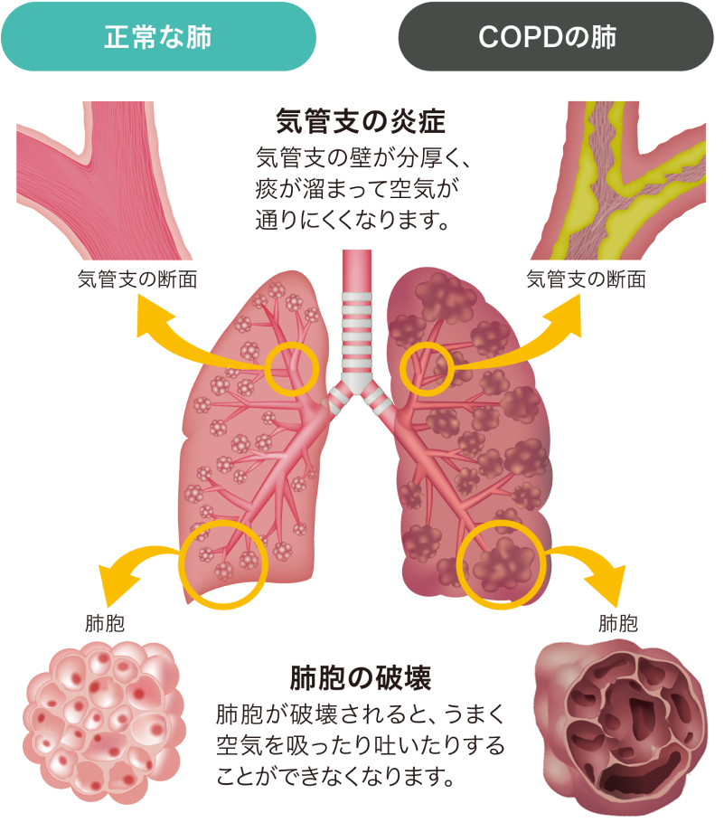 咳・痰・息切れなどの症状はCOPDが原因かもしれません これらの症状を放っておくと日常生活に支障が出る可能性があります