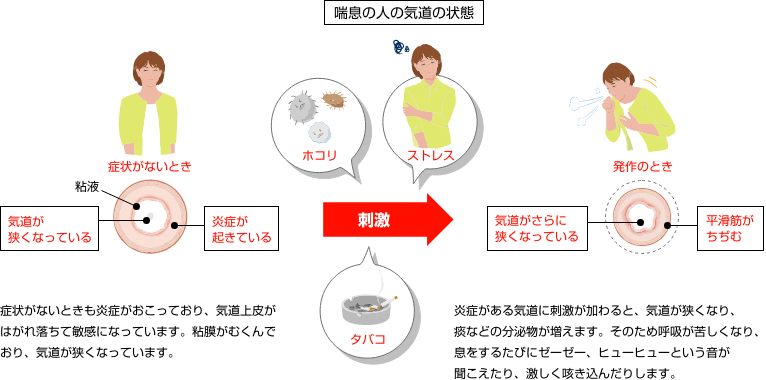 喘息の人の気道の状態