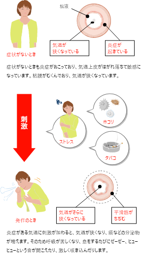 喘息の人の気道の状態